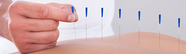 acupuncture